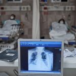 Una radiografía de un paciente con covid-19. Foto: Iván Macías